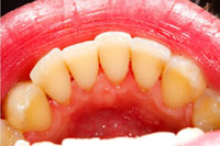 Abbildung einer Zahnreihe nach erfolgter Belagentfernung
