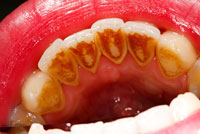 Abbildung einer Zahnreihe mit deutlichen Verfärbungen